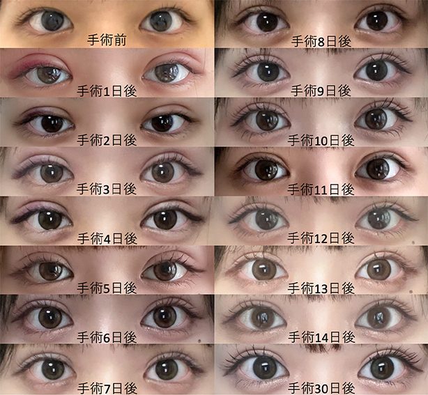 腫れが強い経過