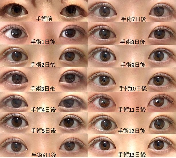 腫れが少ない経過