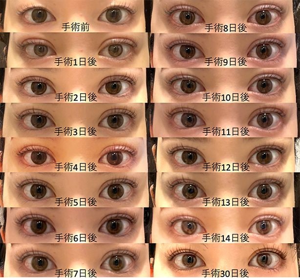 平均的な腫れの経過