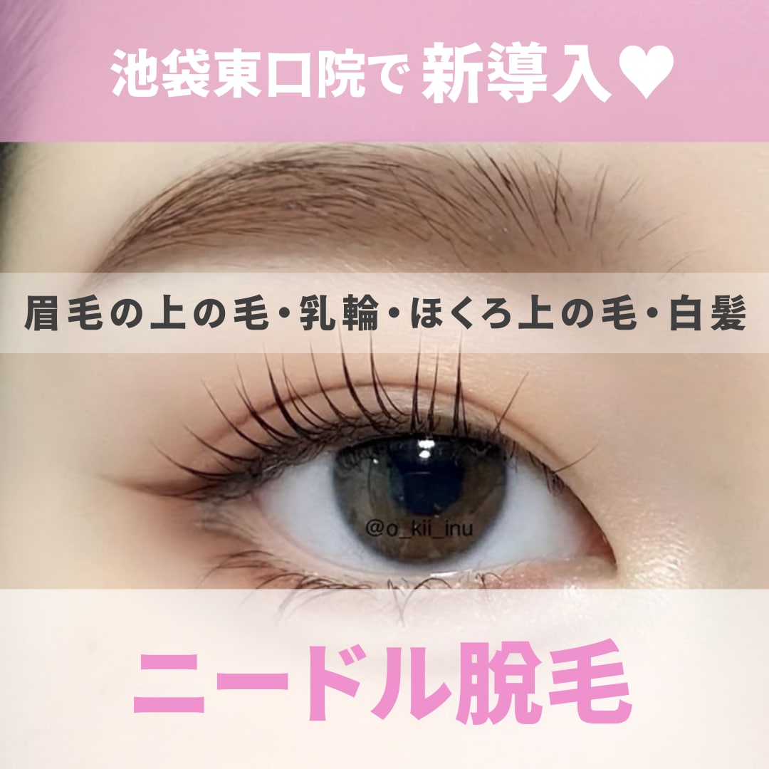 池袋東口院✨【新導入】ニードル脱毛✨💉