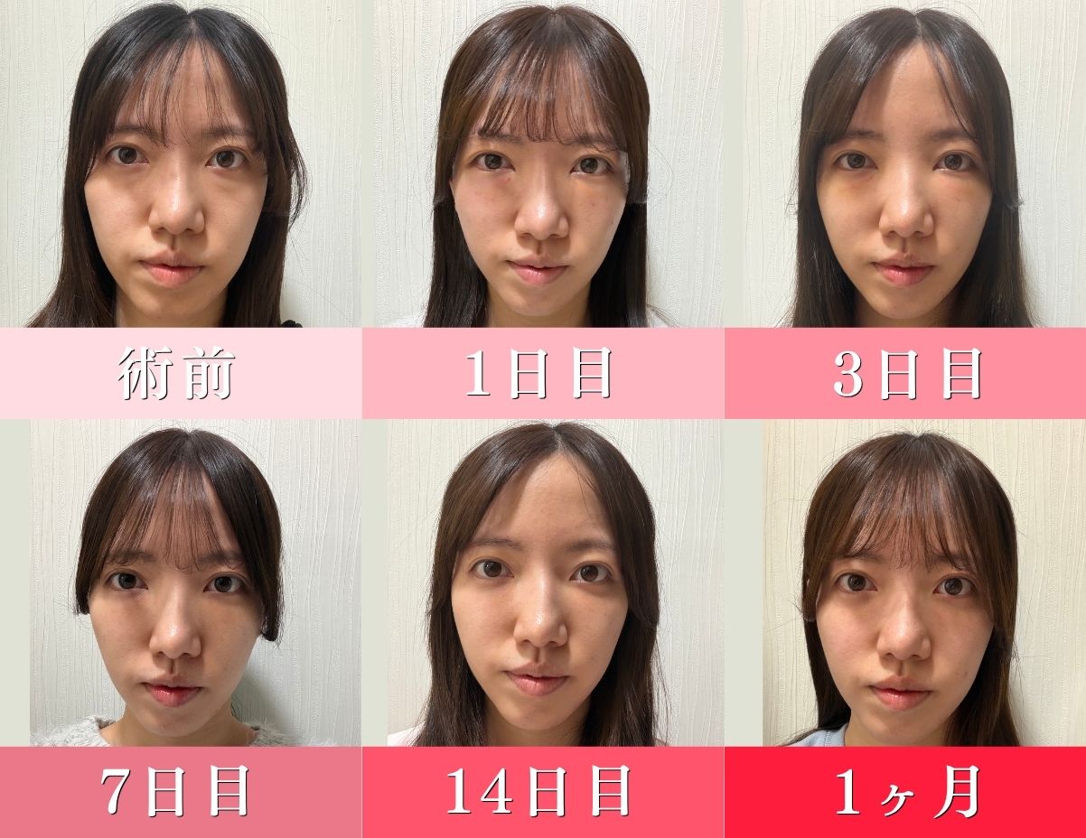 ダウンタイム経過