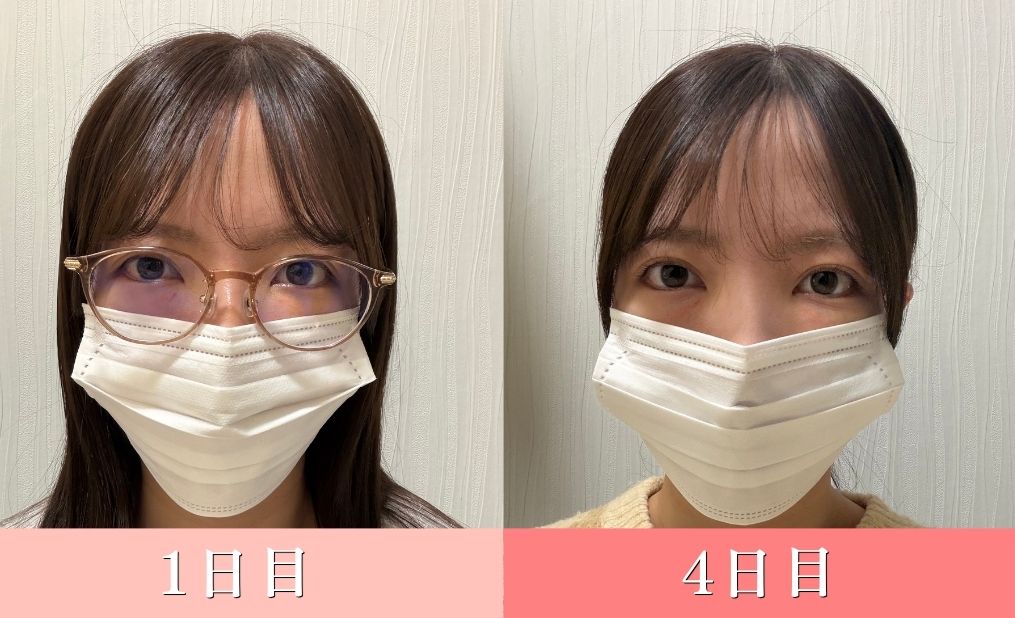 ダウンタイム隠し方