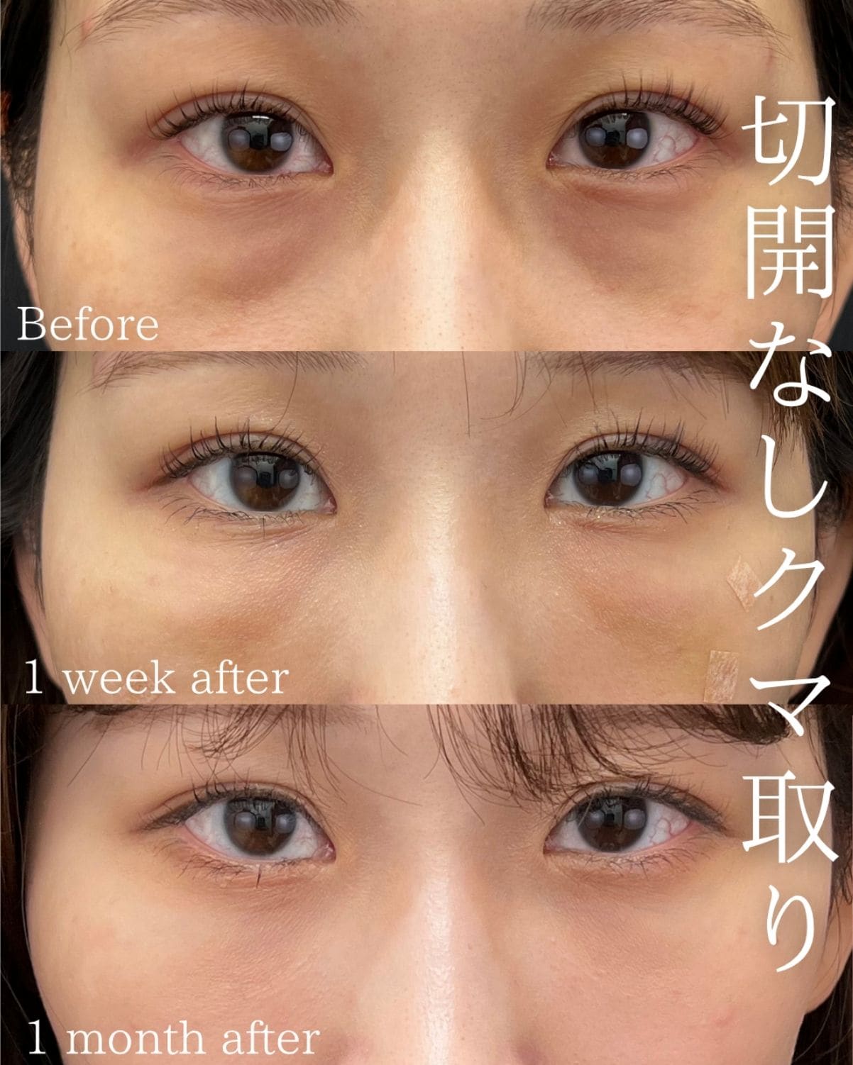 <ul><br />
【目の下の切らないクマ取り・たるみ（ふくらみ）取り】<br />
【コンデンスリッチフェイス（脂肪注入）】<br />
【ナノリッチ（脂肪注入）】<br />
<ul/>