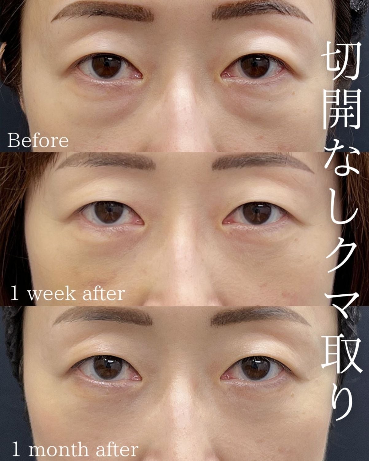 【裏ハムラ法（経結膜アプローチ）単独】