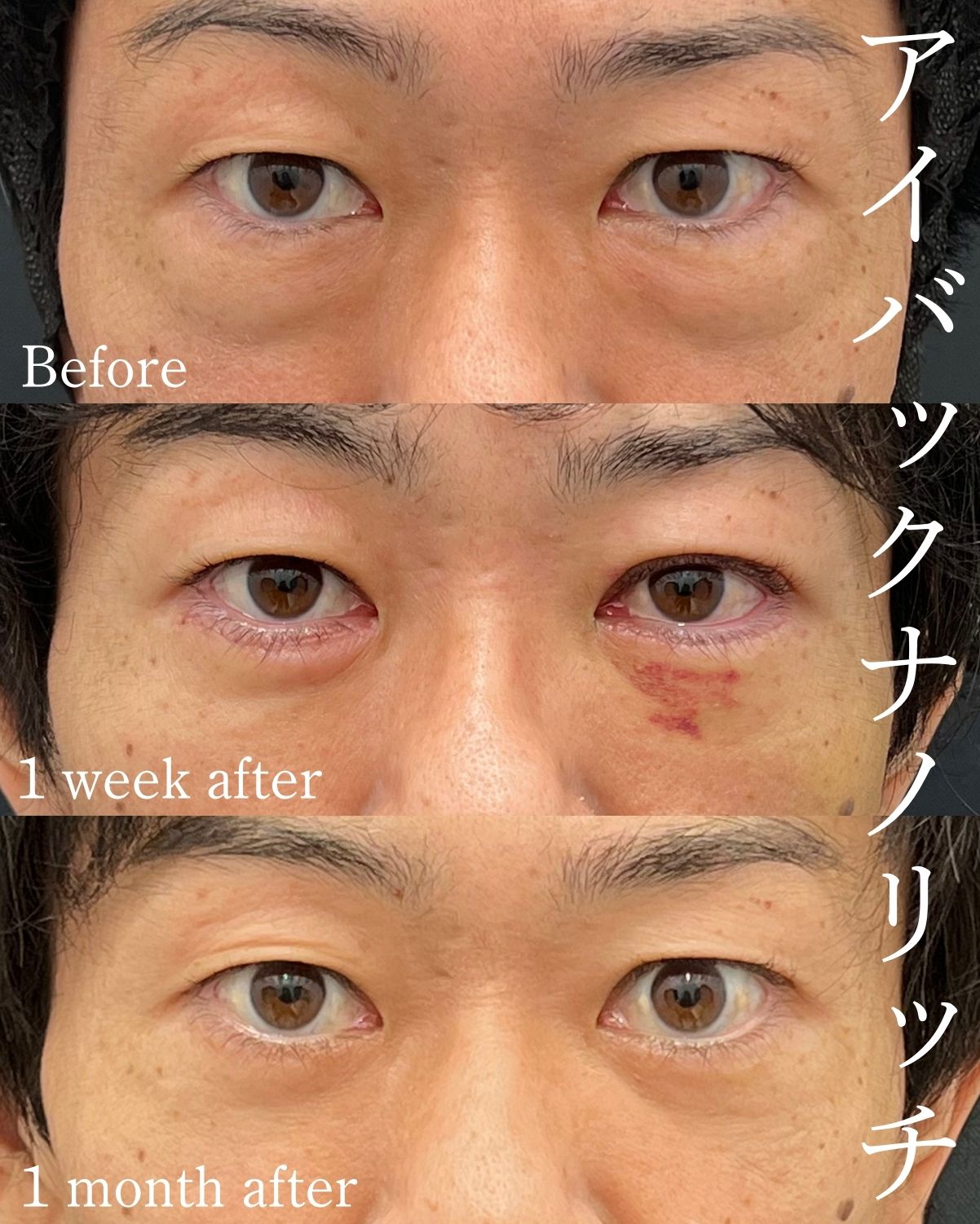 <ul><br />
【アイバックリムーブ】<br />
【コンデンスリッチフェイス（脂肪注入）】<br />
【ナノリッチ（脂肪注入）】<br />
<ul/>