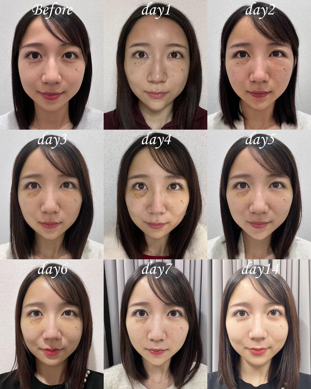 <ul><br />
🌸ダウンタイムの弱い方🌸<br />
【目の下の切らないクマ取り・たるみ（ふくらみ）取り】<br />
【コンデンスリッチフェイス（脂肪注入）】<br />
【ナノリッチ（脂肪注入）】<br />
【糸リフト（テスリフト）】<br />
<ul/>