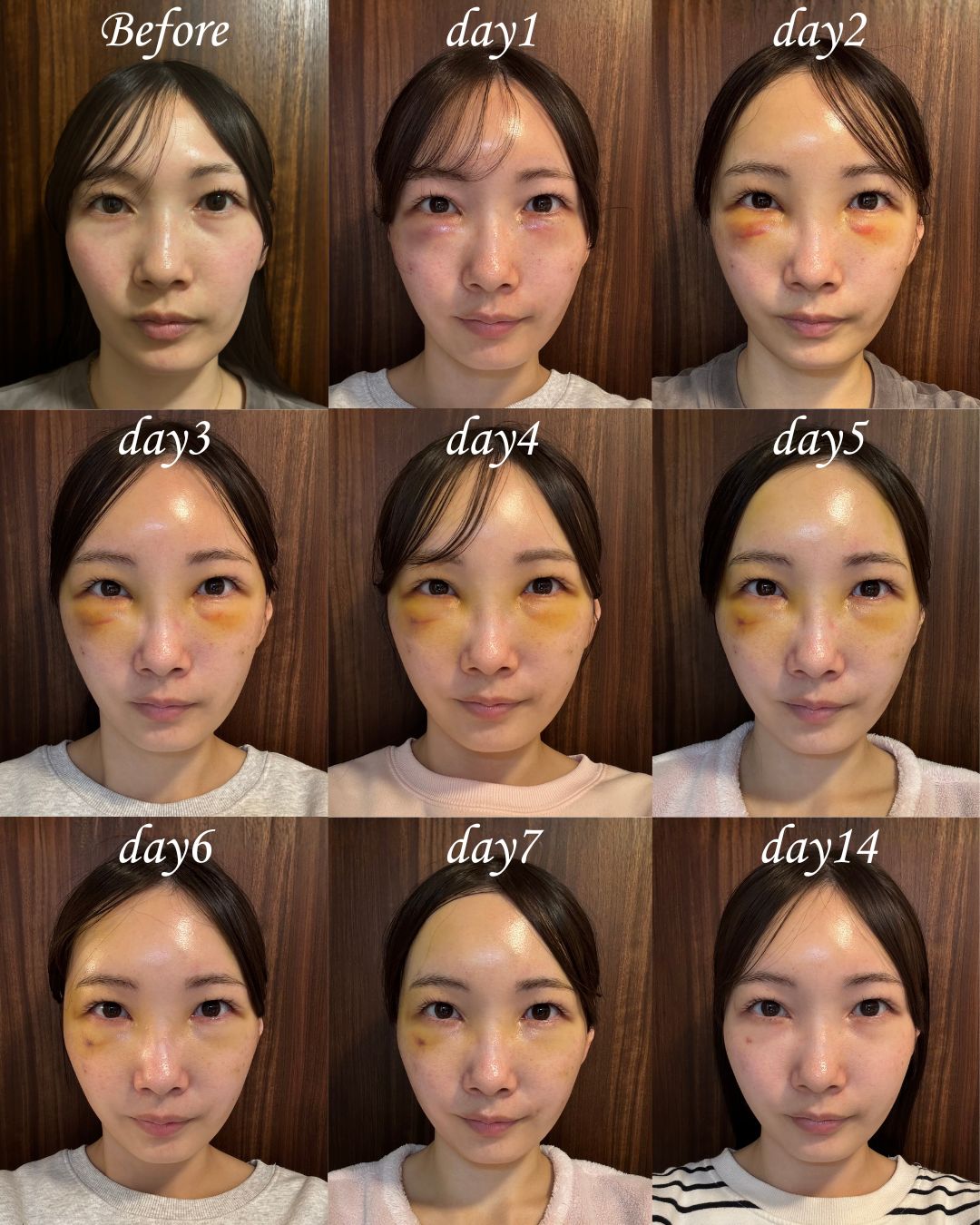 <ul><br />
🌼ダウンタイムの強い方🌼<br />
【目の下の切らないクマ取り・たるみ（ふくらみ）取り】<br />
【コンデンスリッチフェイス（脂肪注入）】<br />
【ナノリッチ（脂肪注入）】<br />
【糸リフト(プリマリフト)】<br />
<ul/>