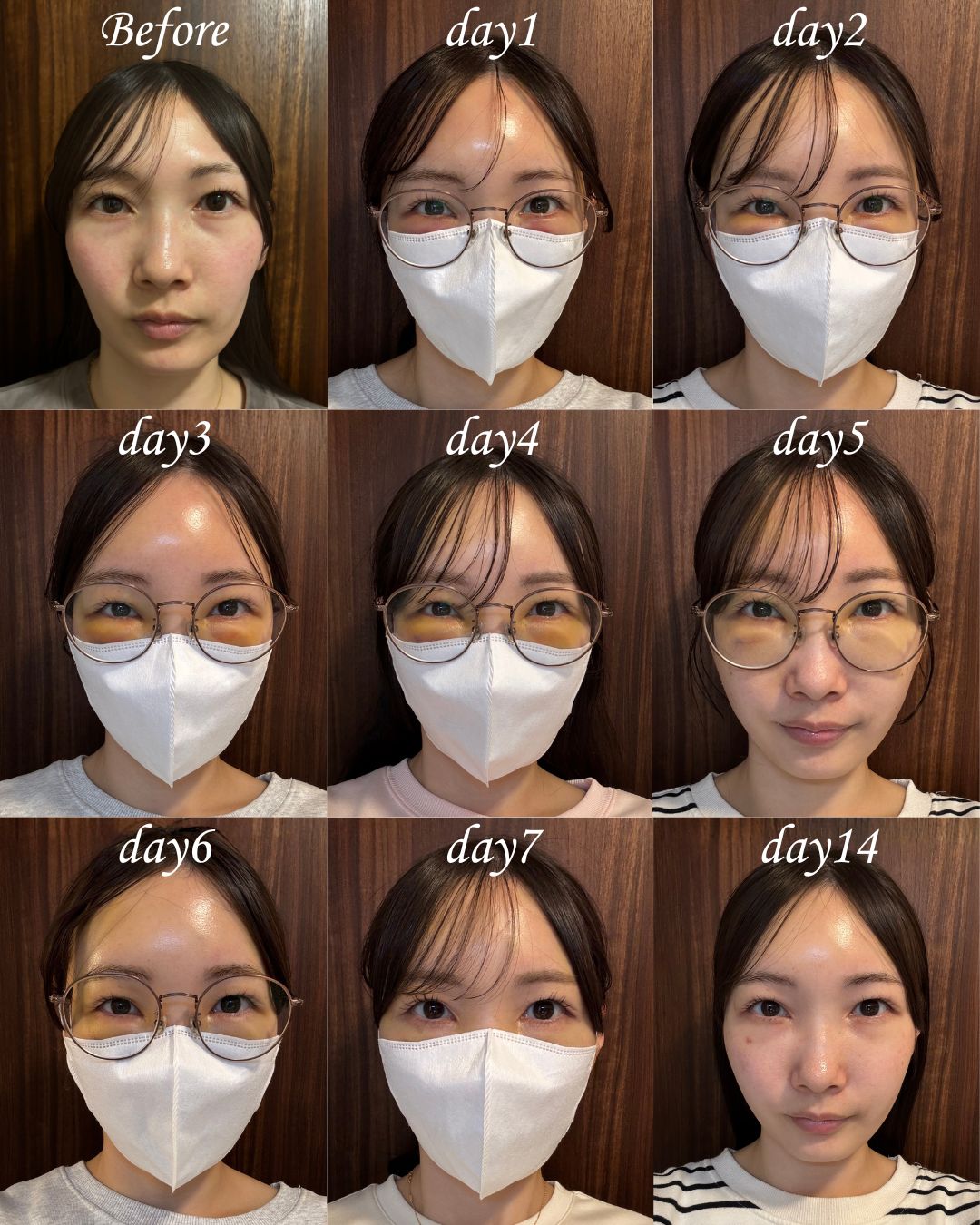 気になるクマ取り後の『ダウンタイム』🔍<br />
ダウンタイムの隠し方をぜひご参考になさってください✨