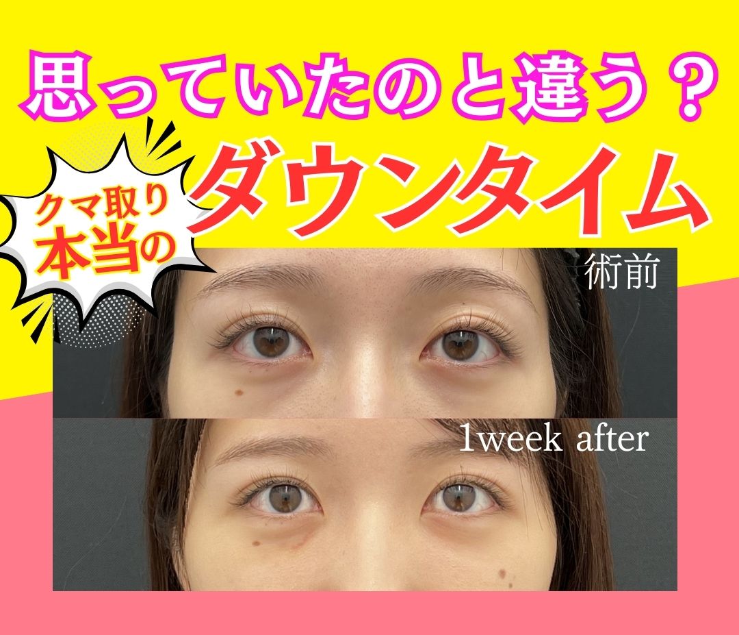 思っていたのと違う？【クマ取りダウンタイム】初心者必見🔰｜湘南美容池袋東口院👩‍⚕️高山真実医師