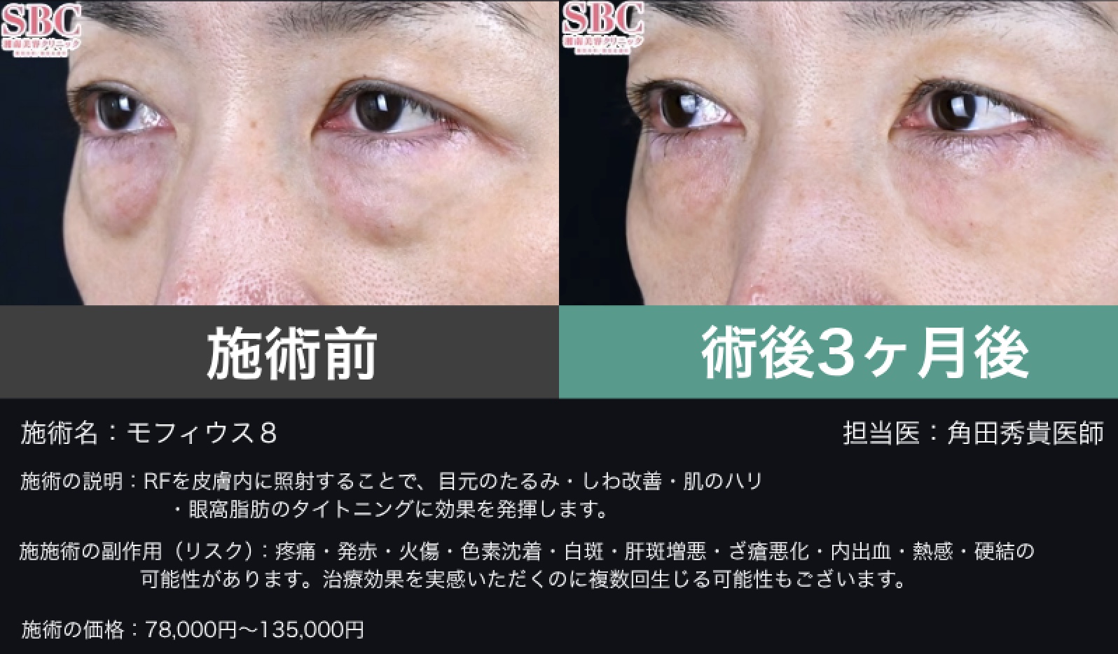 モフィウス８