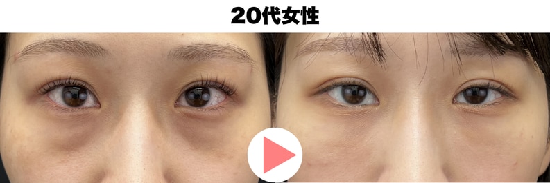 20代クマ取り症例写真