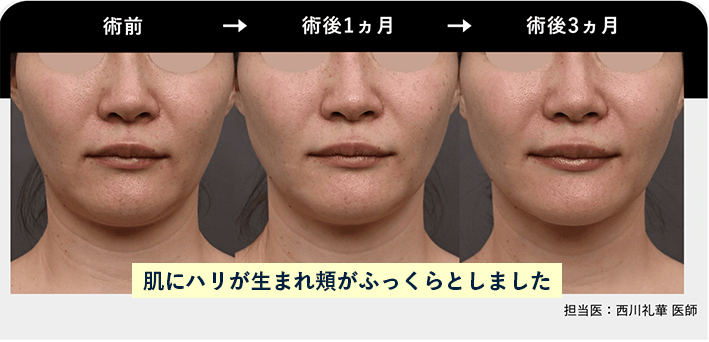 SBCハイフプログラム全顔と首の施術前・1か月後・3か月後の症例