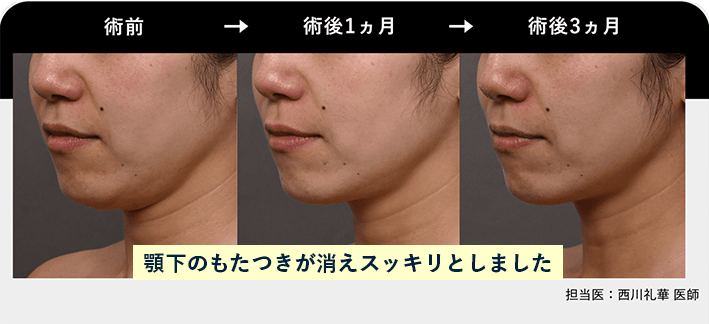 SBCハイフプログラム全顔と首の施術前・1か月後・3か月後の症例