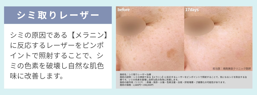 濃いシミを一掃したい方：シミ取りレーザー