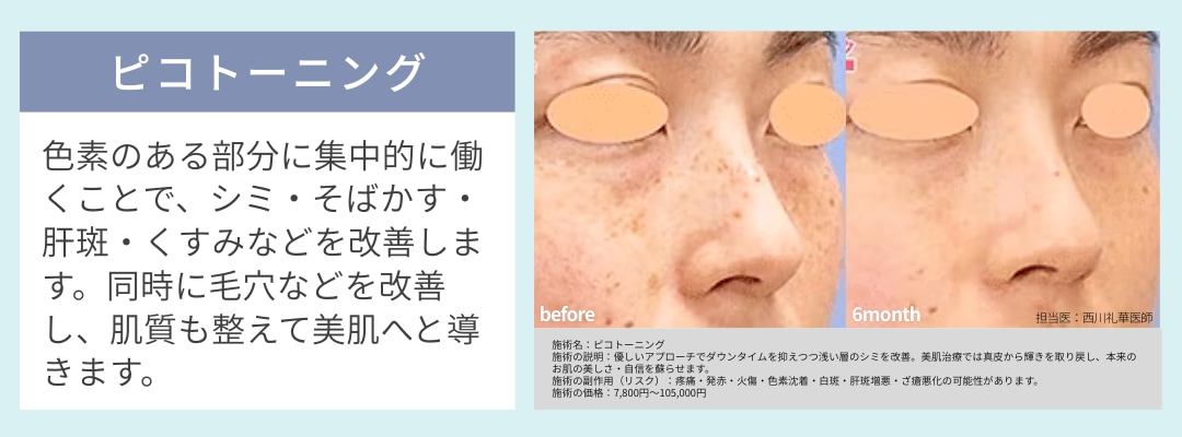 肝斑・くすみを改善したい方：ピコトーニング