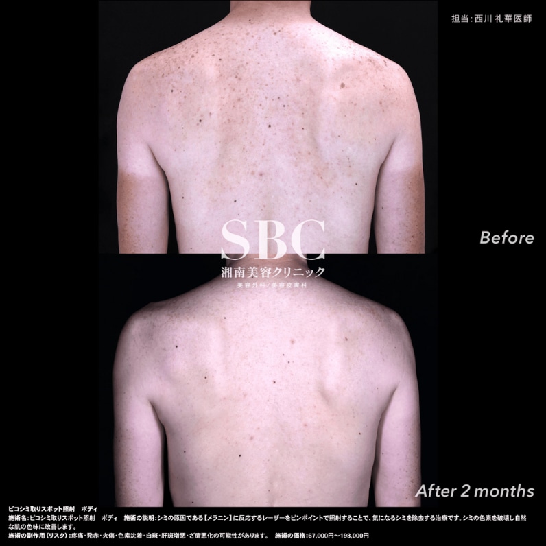 背中のシミを直したい方：シミ取りレーザー（背中）