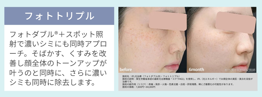 シミだけでなく小ジワや毛穴も改善：フォトトリプル