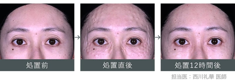 処置前~処置12時間後