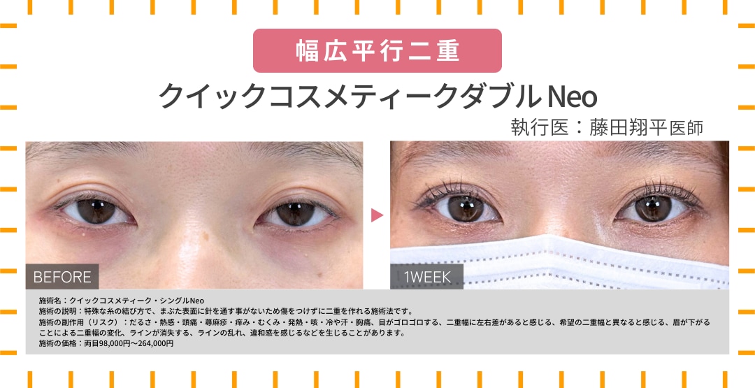 幅広平行二重