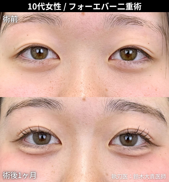 末広二重