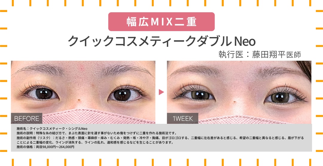 幅広MIX二重