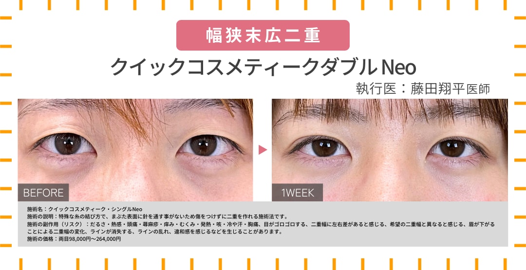 幅狭末広二重