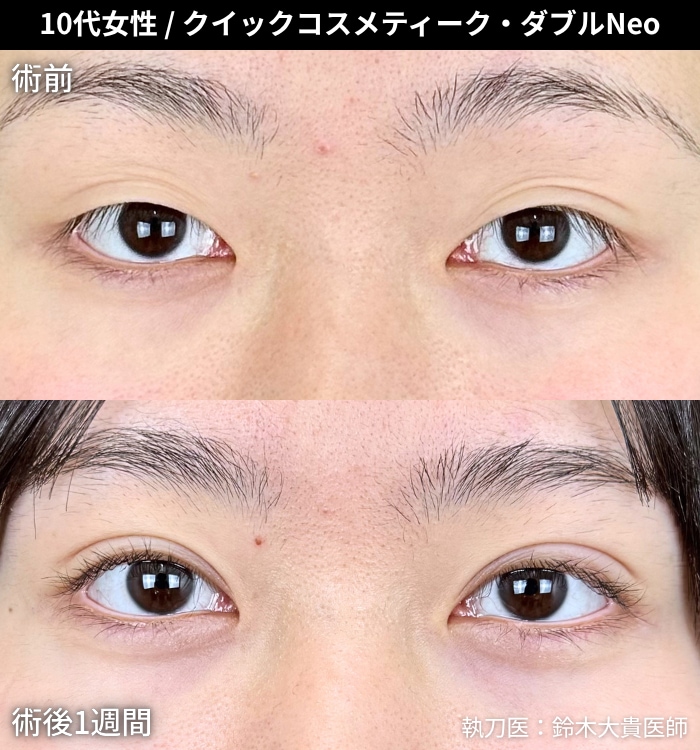 【圧倒的人気】クイックコスメティーク・ダブルNeo