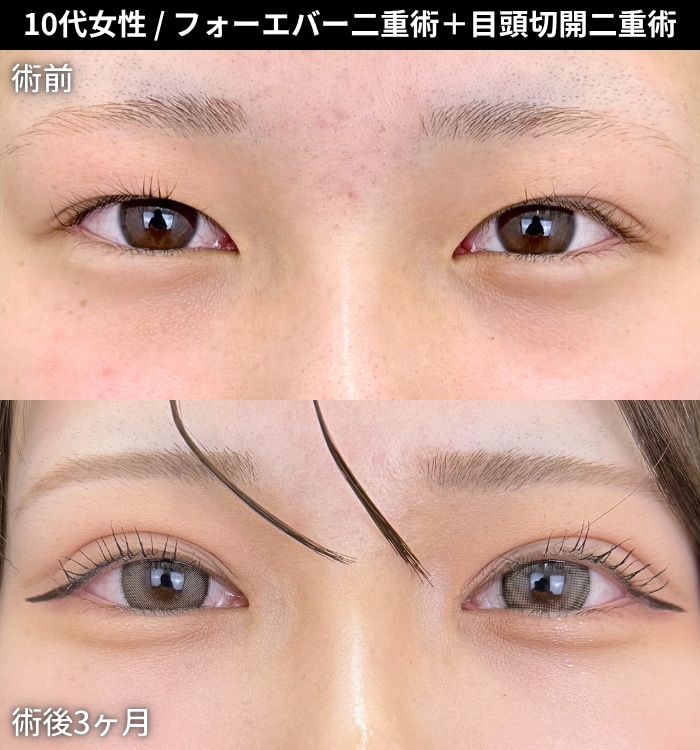 フォーエバー二重術＋目頭切開プレミアム