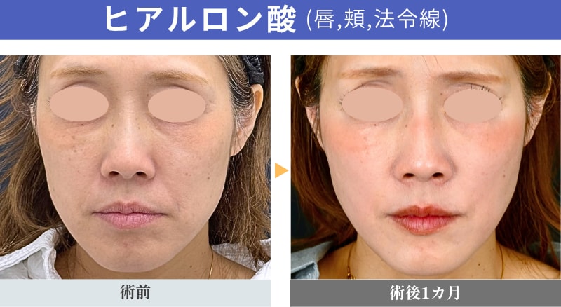 骨格と理想を掛け合わせた「一番似合う二重」のご提案