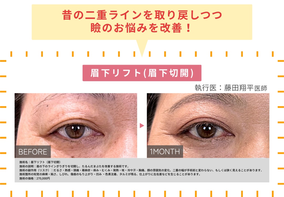 眉下リフト(50代女性)