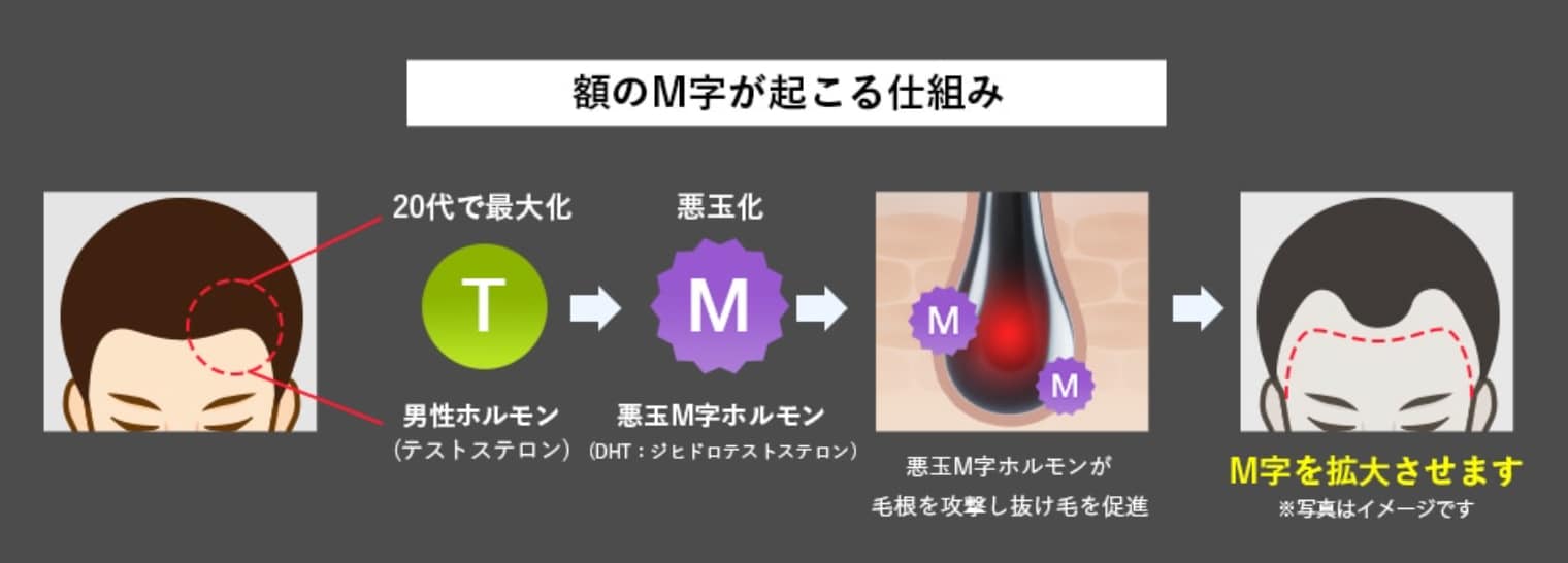 額のＭ字の原因は体内の「悪玉M字ホルモン」