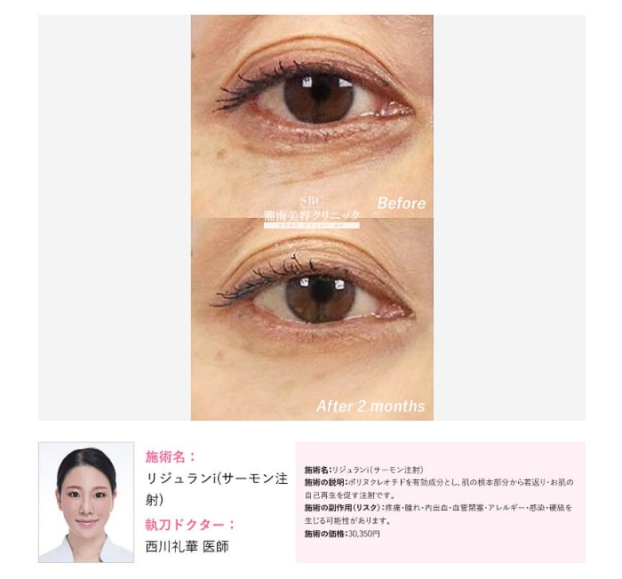 リジュランi 症例写真