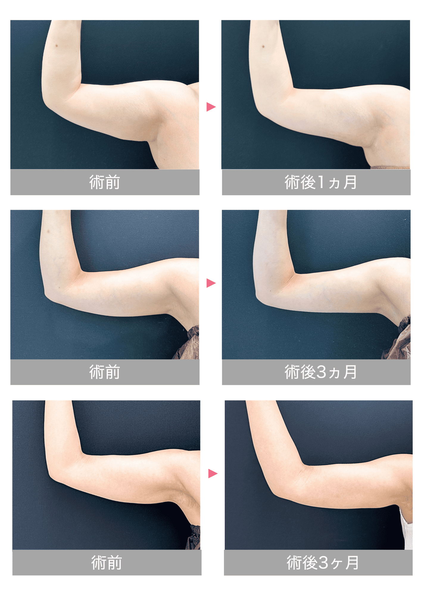 二の腕脂肪吸引