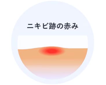 治りにくいニキビ跡の種類