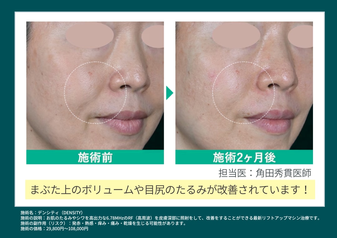 デンシティ症例