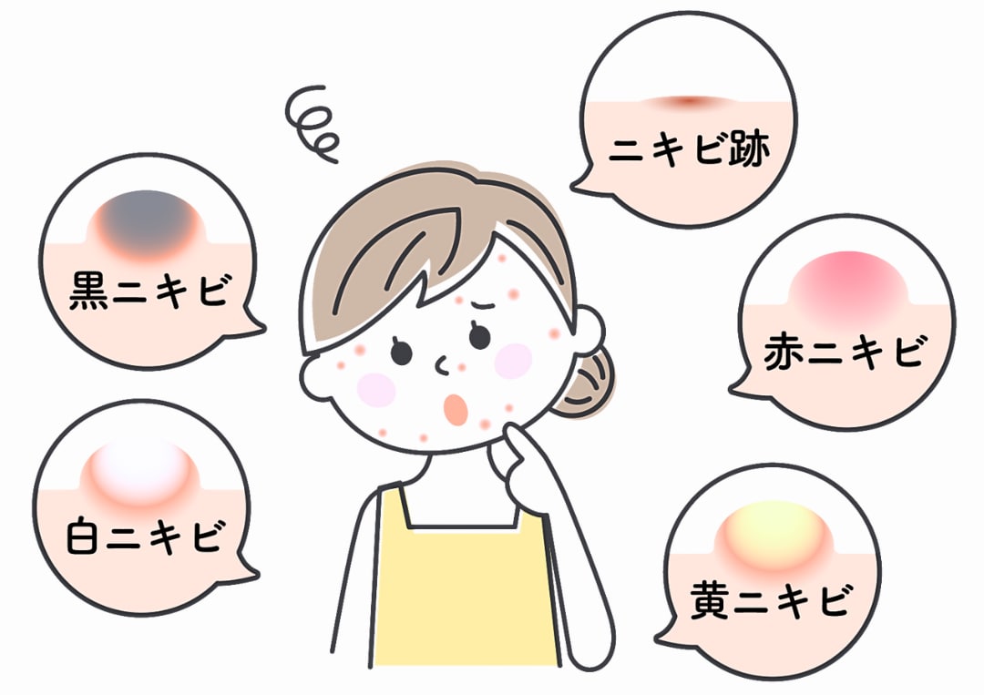 ニキビの進行度と種類