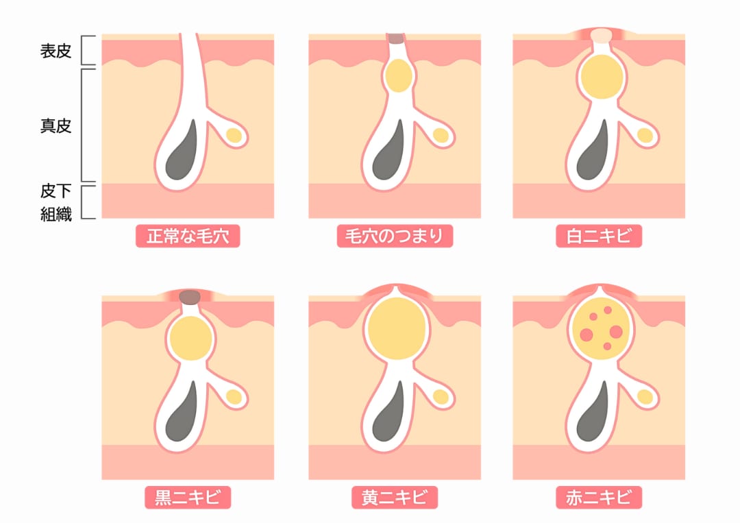 ニキビの主な要因