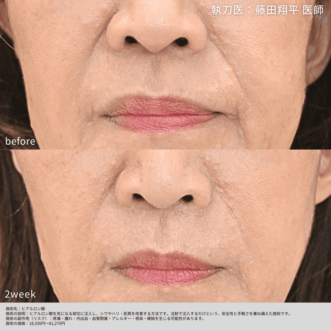 ヒアルロン酸(ほうれい線)