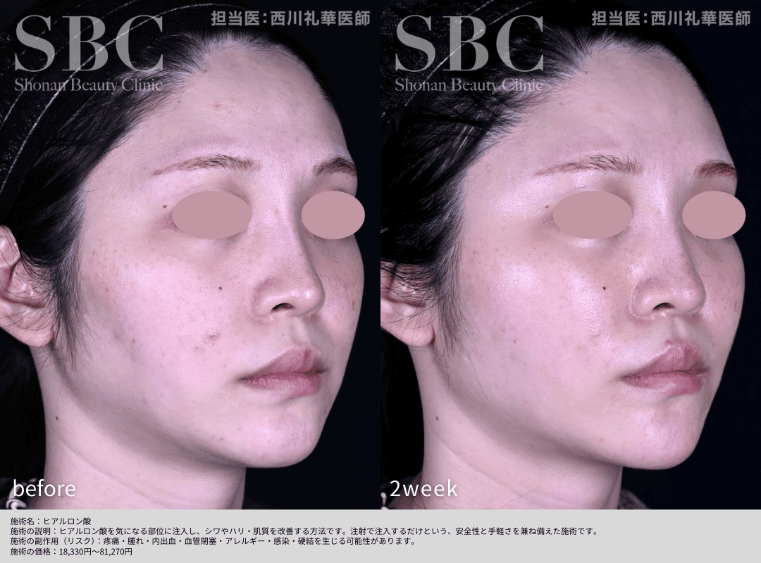 ヒアルロン酸（額・頬・顎）