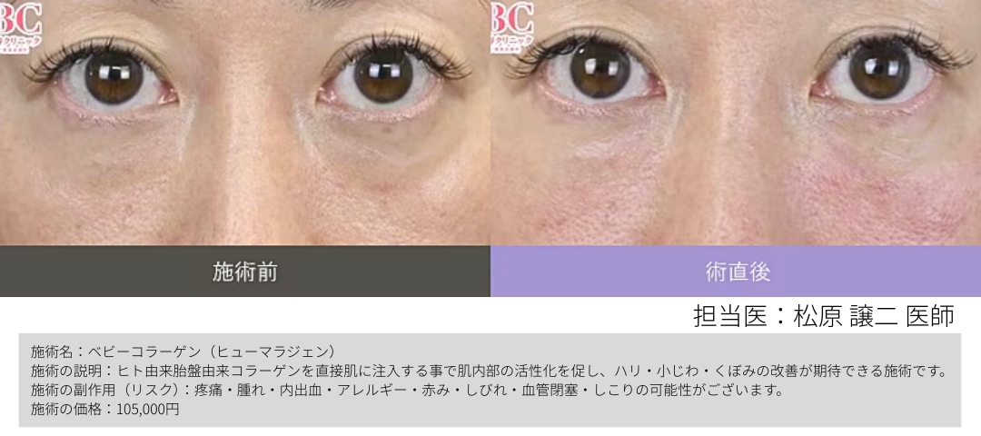 ダウンタイムが比較的軽い