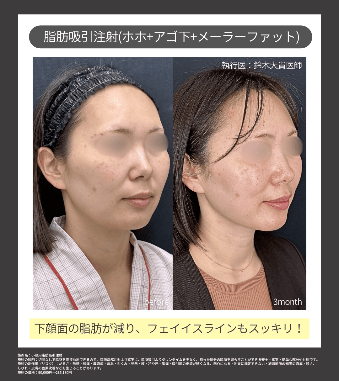 脂肪吸引注射