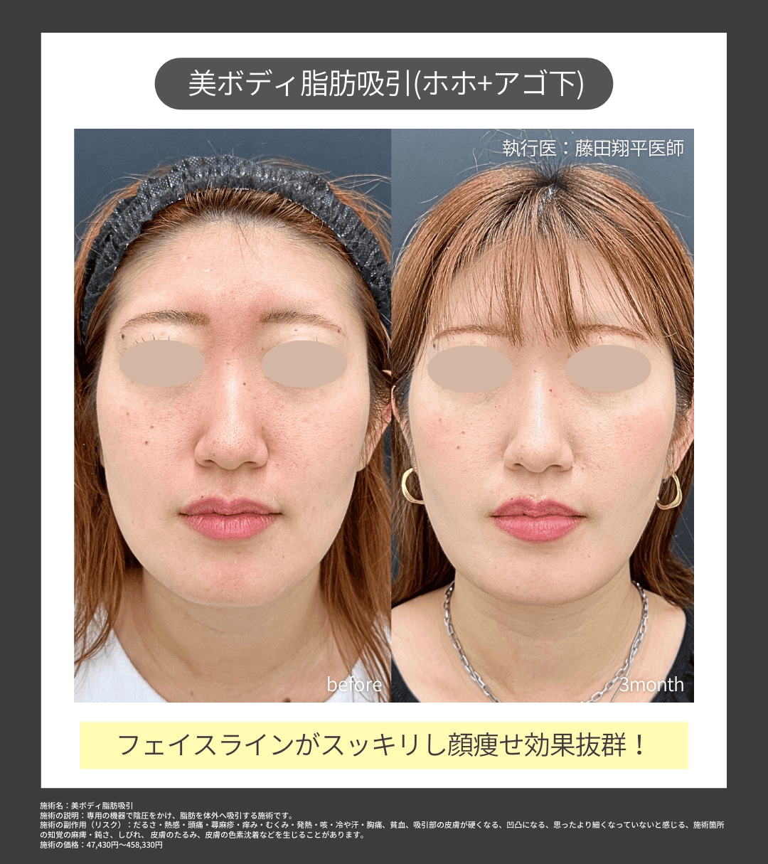 美ボディ脂肪吸引