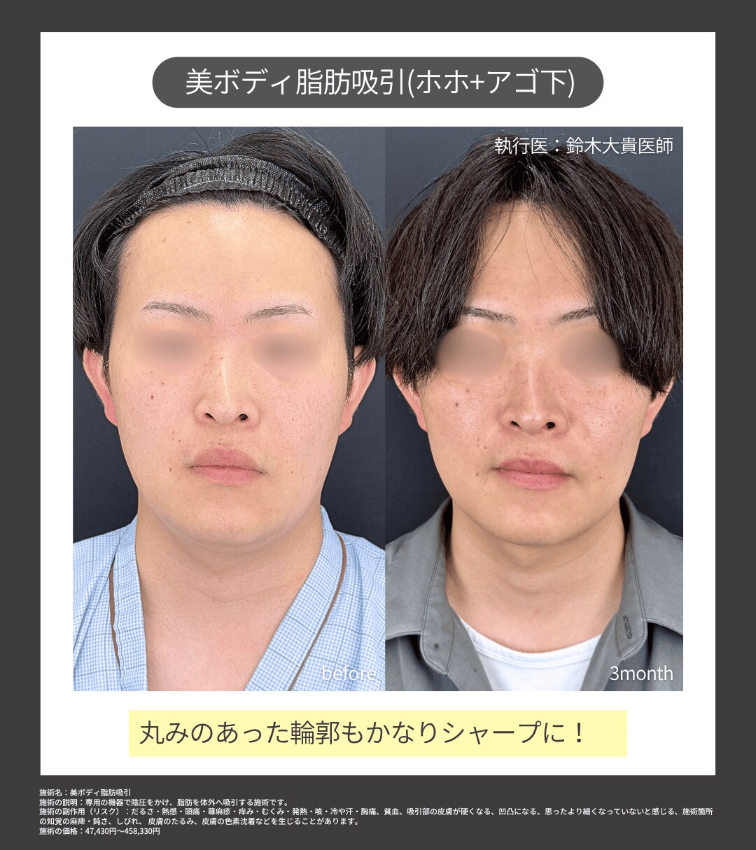 美ボディ脂肪吸引