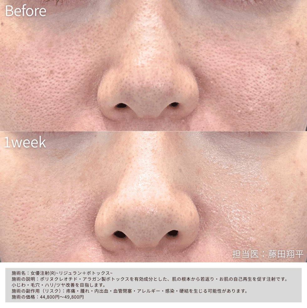 【頬の開き毛穴・乾燥】30代女性 女優注射®(リジュランHB＋ボトックス) 術前~術後1週間