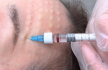 どれくらいで腫れが引きますか？