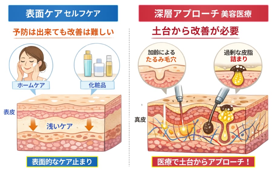 原因は肌の奥にある真皮層の衰えと皮脂腺