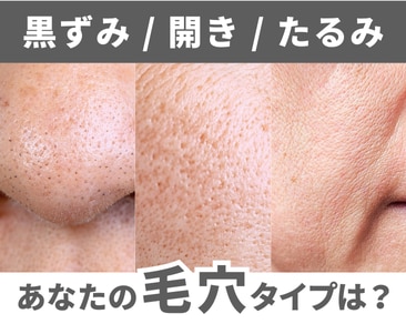 いわきで毛穴治療・毛穴洗浄なら湘南美容クリニックいわき院（黒ずみ・開き毛穴・たるみ毛穴）