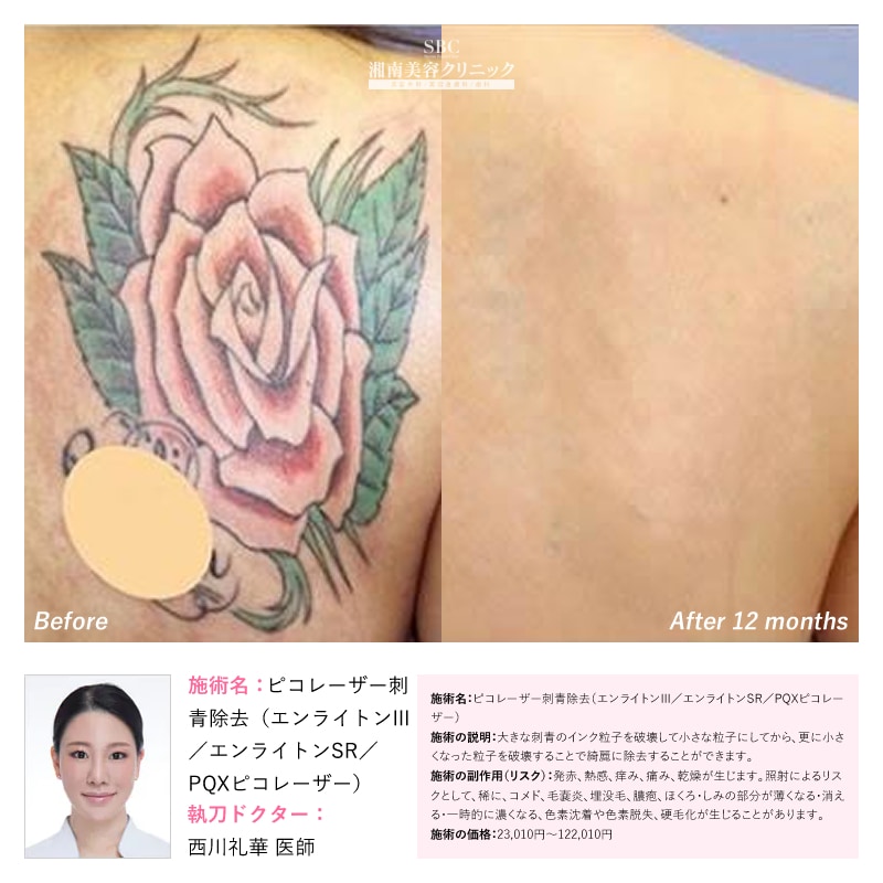 背中(施術後12ヶ月後)