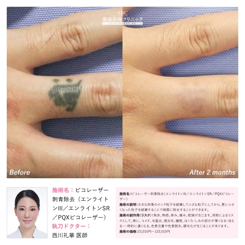 指(術後2ヶ月経過)