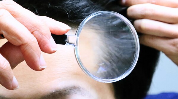 マイクロスコープでの頭皮診断も可能